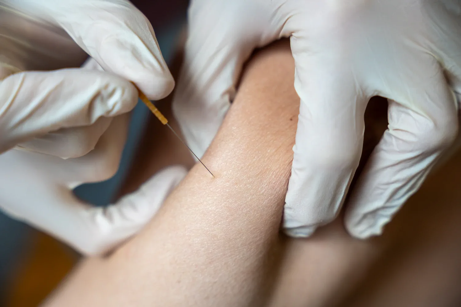 Gloved hands performing acupuncture on skin